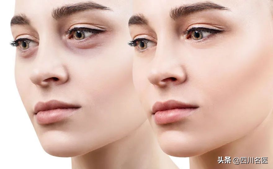 熬夜熬出黑眼圈怎么解决,熬夜熬出了眼袋黑眼圈