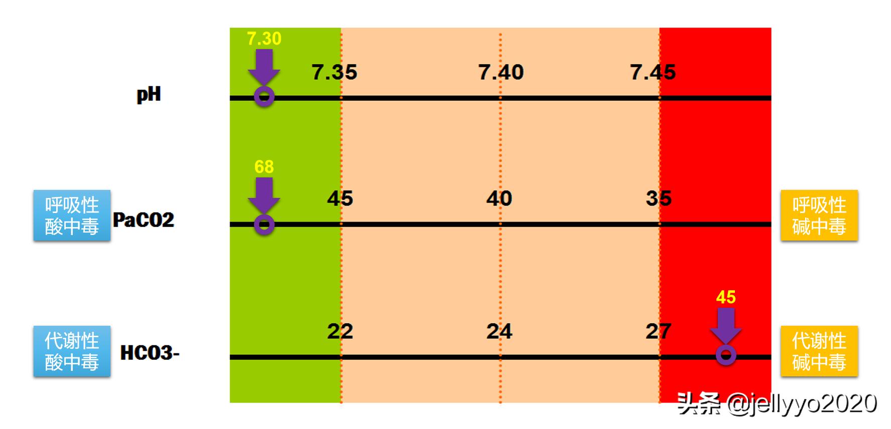 血气分析的最佳判断方法,血气分析怎么判断混合性酸碱平衡
