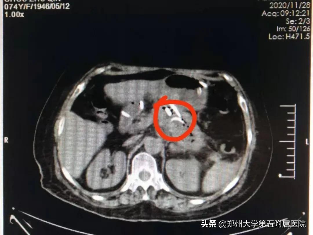 超声内镜下胰腺囊肿穿刺引流术,超声内镜下胰腺囊肿手术