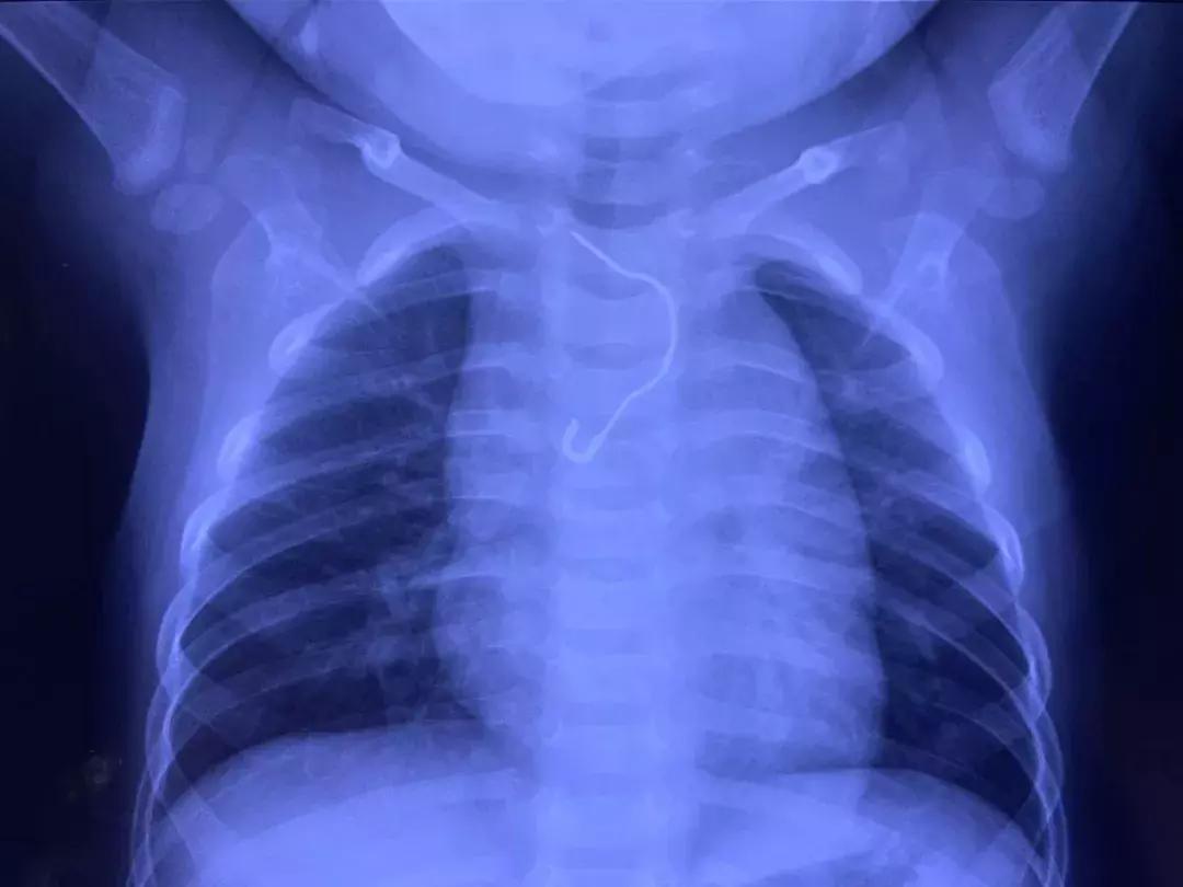 宝宝误食别针怎么办,宝宝吞别针