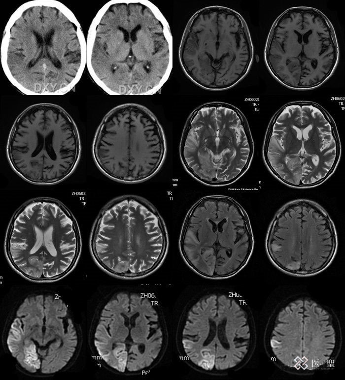 如何正确认识肺癌,肺癌第四阶段算几期