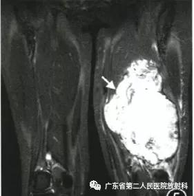 这个病例让我大涨知识：14岁男性右小腿痛性包块