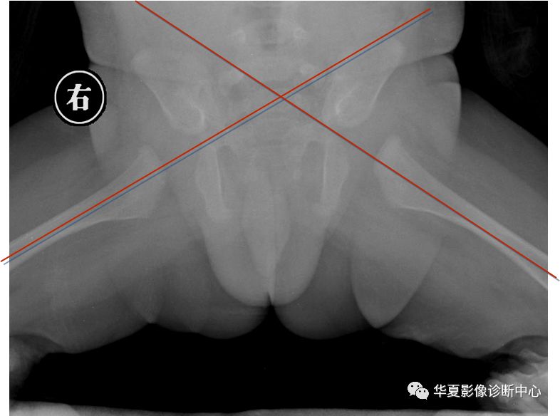先天性髋关节脱位饮食,先天性髋关节脱位属不属于残疾人