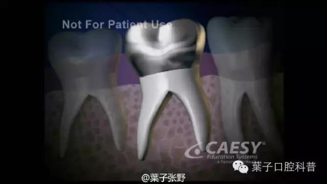 上牙龈上火突出一个鼓包,牙龈肿胀鼓包上火了吗