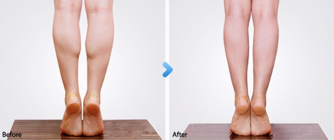 小腿粗怎么可以瘦小腿,拉伸小腿能瘦小腿吗