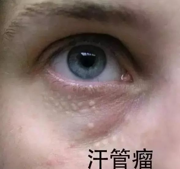 为什么脸上总反反复复长脂肪粒,脂肪粒反反复复怎么办