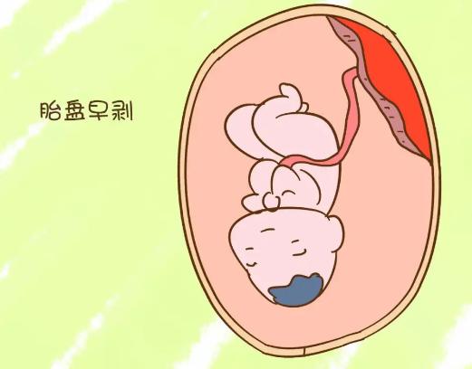 女性32岁胎盘早剥大出血,34周孕妇突然胎盘早剥大量出血