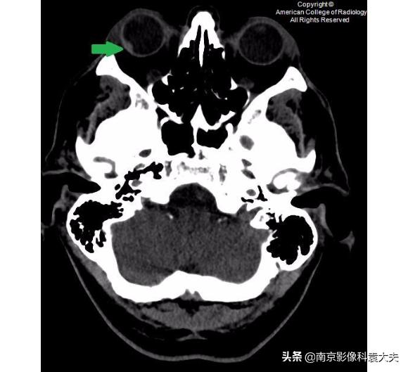 一39岁男子争吵后，右眼突然瞎了，病例分析知答案