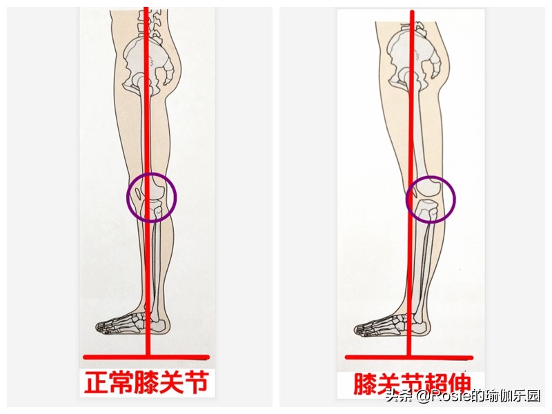锻炼小腿内侧肌肉改善O型腿,小腿粗大腿壮如何变细腿