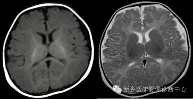 脱髓鞘样改变的mri表现,髓鞘形成稍延迟区
