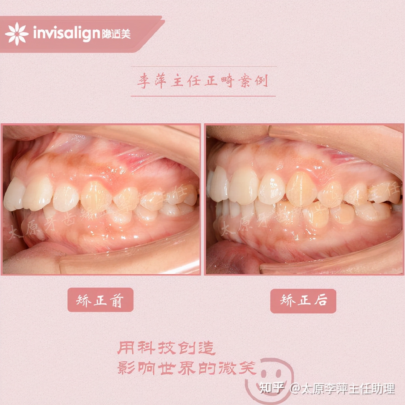 重度拥挤矫正牙齿适合隐形牙套吗,广州成人牙齿矫正推荐隐形牙套