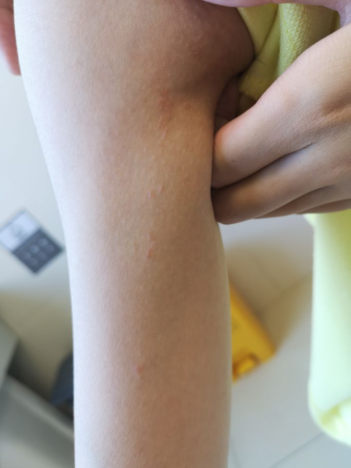 长成圆圈形状是癣还是湿疹,线状苔藓是什么原因造成的