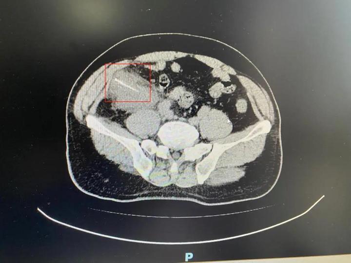 吃饭被鱼刺卡住怎么办,吃饭被鱼刺卡住了怎么办