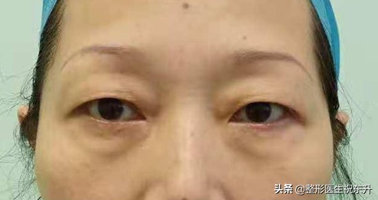 当你老了，上眼皮松了，其实恢复年轻并不难...