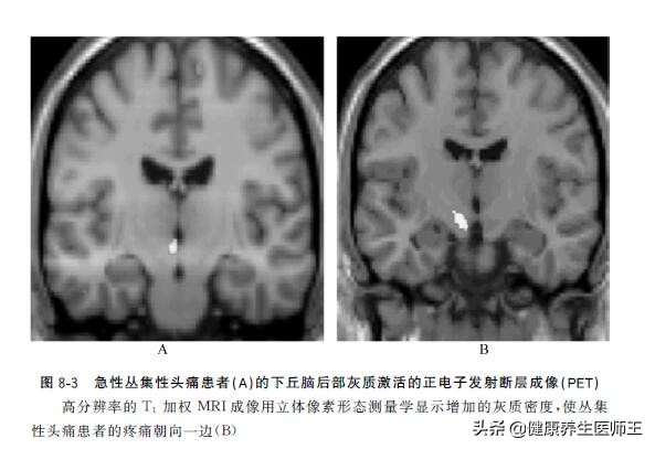 人体健康之丛集性头痛