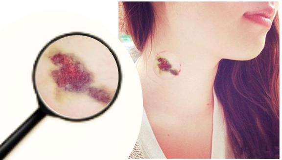 一个吻痕引起的致命性脑梗死事件，医生为你图说其中的机制