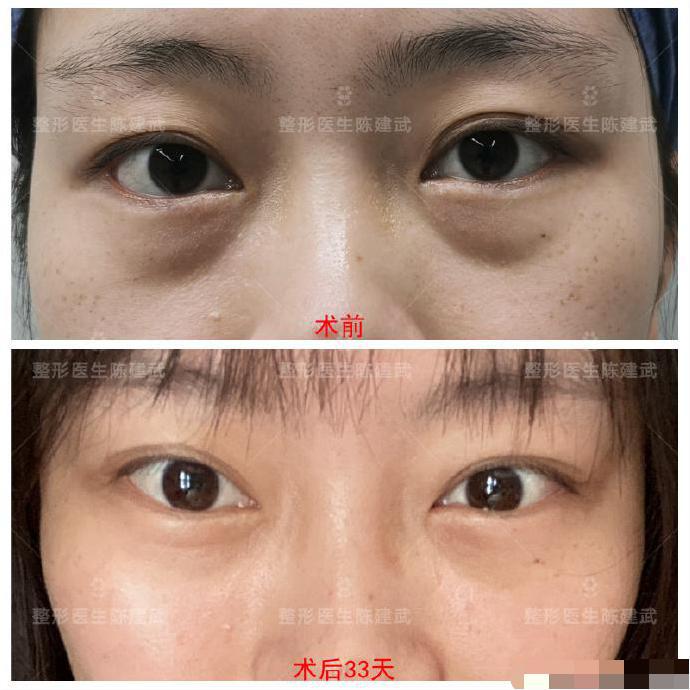眼袋泪沟做完的恢复的视频,眼袋术后下眼睑塌陷怎么修复