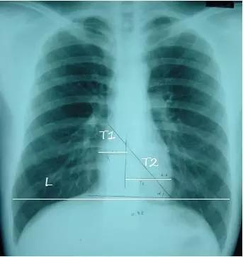 拿到胸片却不会看？送你7个窍门，手把手教你解读胸片（收藏）