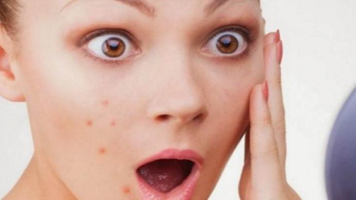 祛痘好方法更快更有效,祛痘最真实的方法