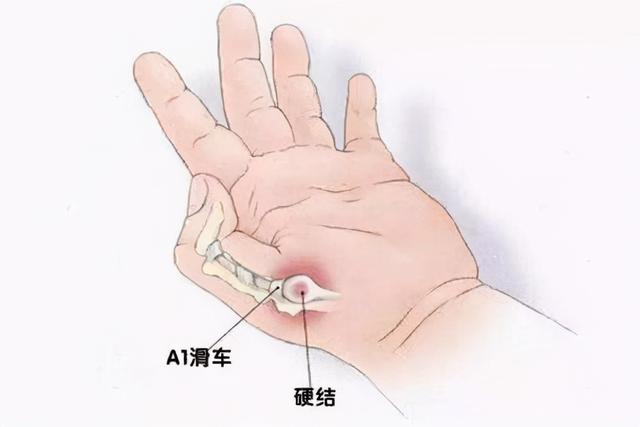 得了妈妈手——腱鞘炎，真的需要封闭治疗吗？杨大夫为你揭秘