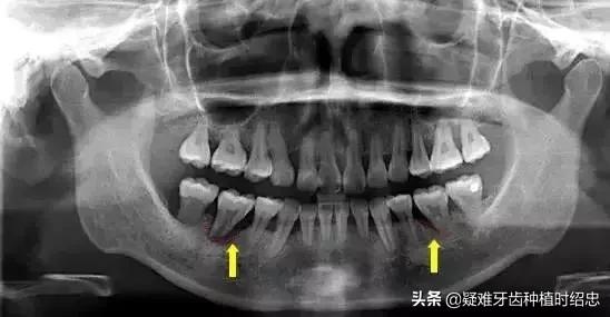 如何预防和治疗牙周炎,矫正完怎么预防牙周炎