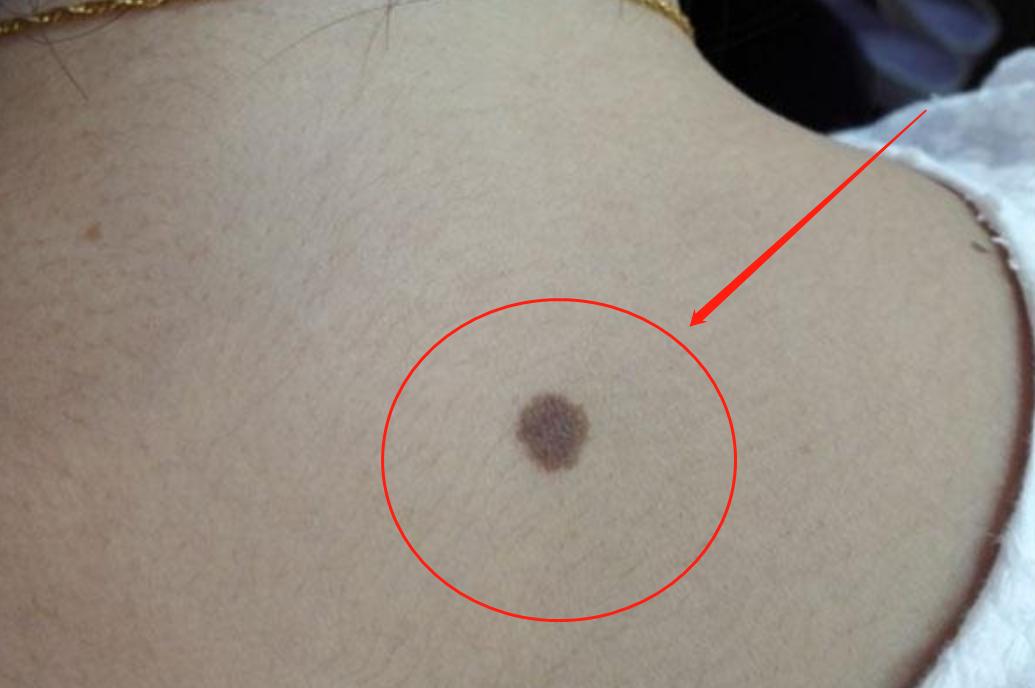 身上的痣自己会消除吗,身上的痣能随便去掉会死吗