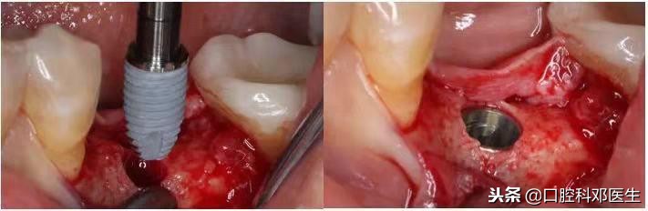 如何看牙省钱牙医教你3个小方法,一个牙医的良心忠告看牙注意事项