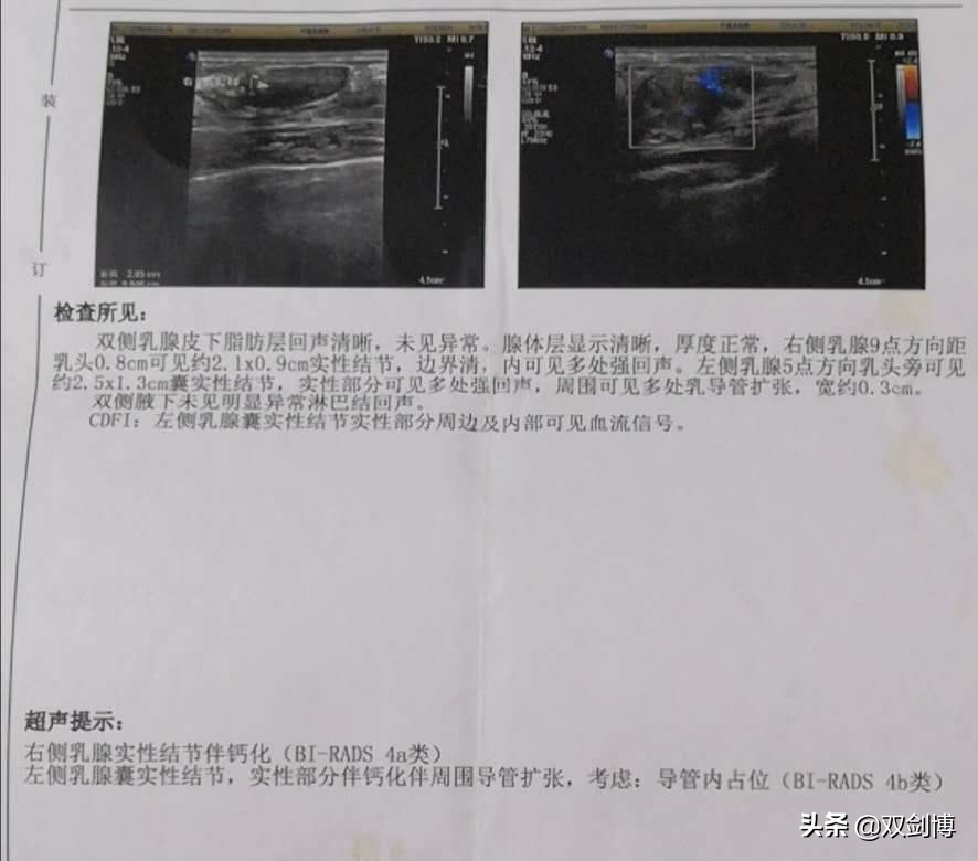 患者问乳房流血是怎么回事？高度怀疑乳腺癌