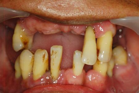 牙病为什么要补牙,牙病经久不愈