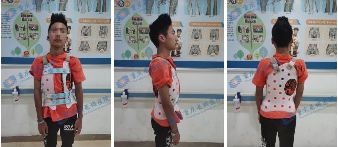 关爱脊柱健康儿童脊柱侧弯,关注脊柱侧弯让孩子少走弯路