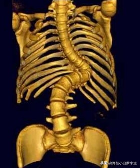 孩子脊柱侧弯怎么治疗,孩子脊柱侧弯最佳治疗方法