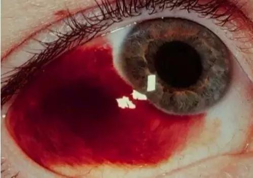 眼底出血是什么原因造成的怎么治,糖尿病眼底出血会发展成什么