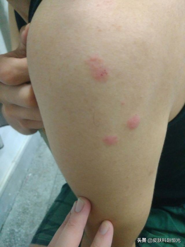 身上突然出现很多红包，奇痒无比，这是什么病？