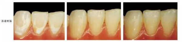 牙齿脱矿涂氟多久可以恢复,牙齿脱矿白斑能自己恢复吗