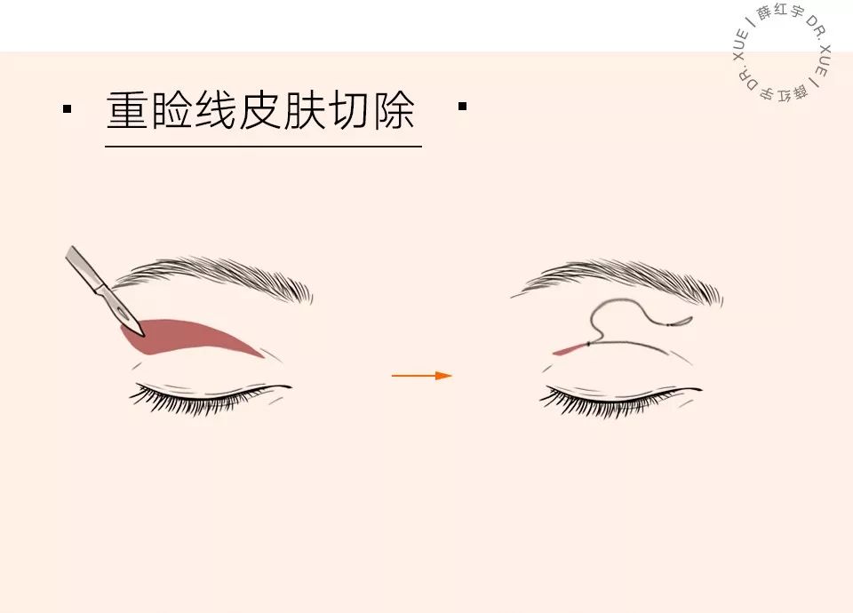 眼部抗衰最好方法,眼部抗衰效果图