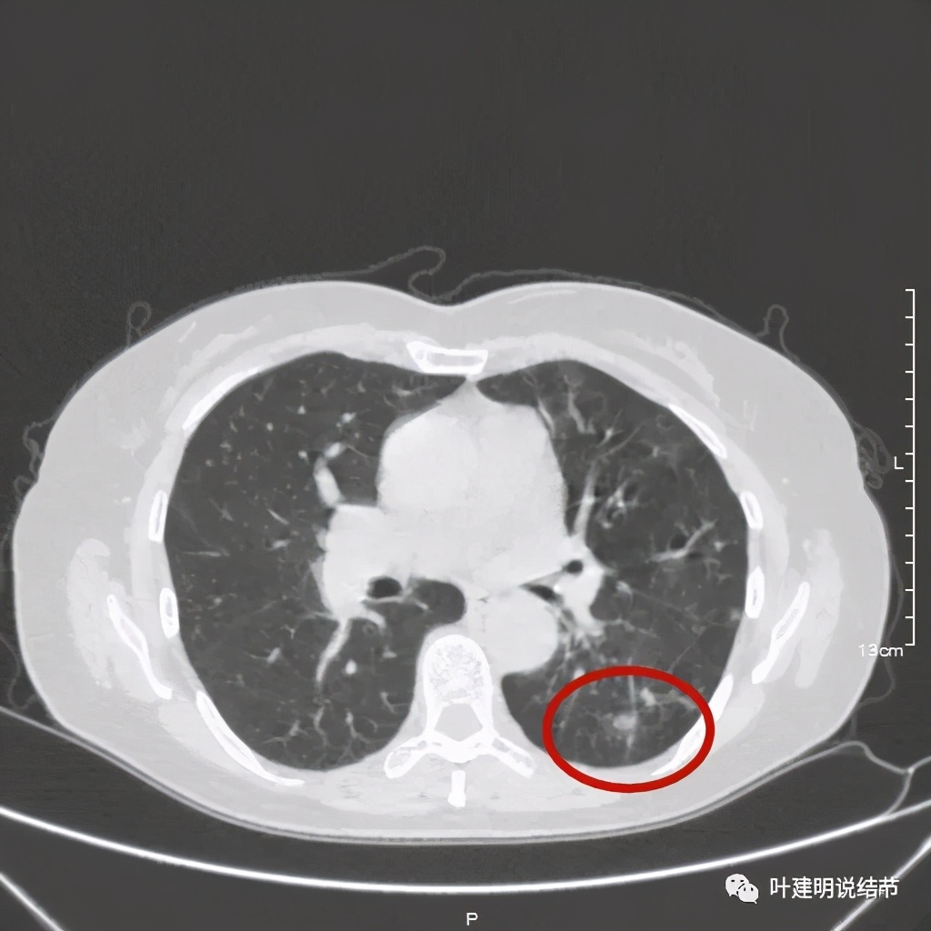 这样的实性结节伴小空洞会是肺癌吗？