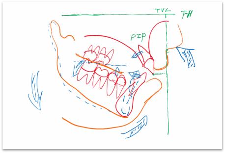 骨性龅牙和牙性龅牙的区别,牙性龅牙和骨性龅牙怎么矫正