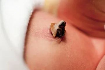 新生儿脐带未脱落发炎流脓,新生儿脐带红肿怎么处理