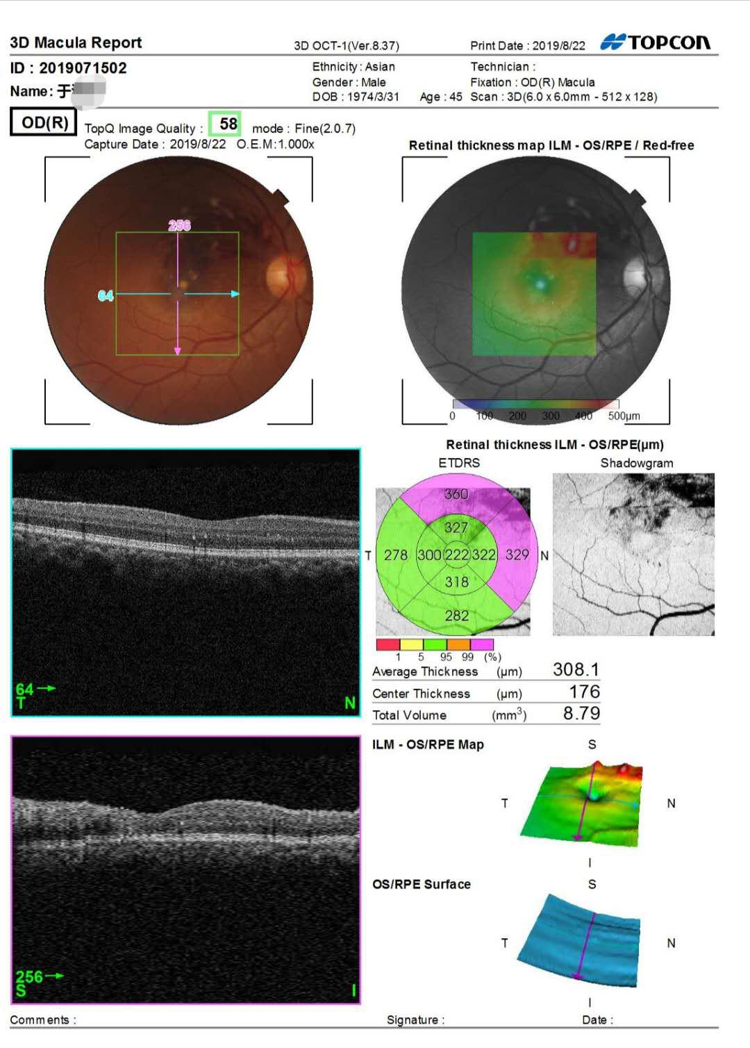 眼科先天性眼底病变,眼底病变医院