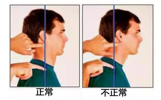 含胸驼背提升气质,含胸驼背气质差怎么办