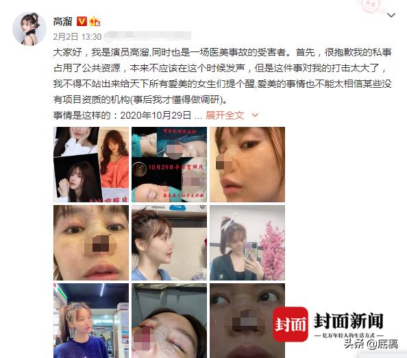 演员高溜整容失败鼻子坏死,演员高溜整容鼻子坏死