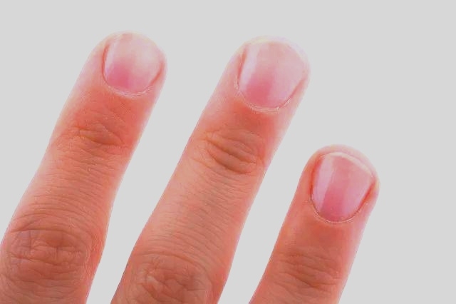 为啥得灰指甲,为什么患上灰指甲