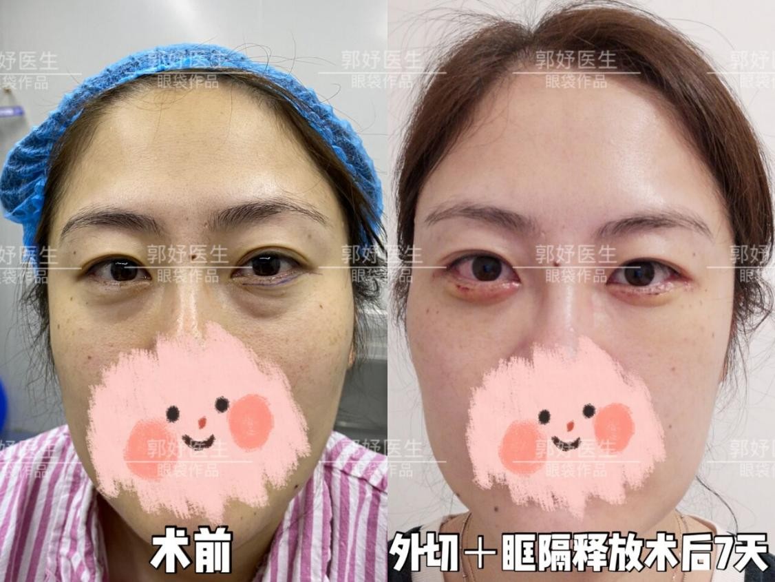 眶隔脂肪释放去眼袋需要多少钱,去眼袋不做眶隔释放可以吗