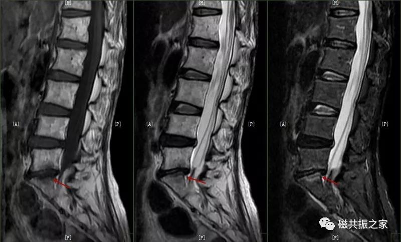 腰椎有哪些病变,腰椎病变有几种