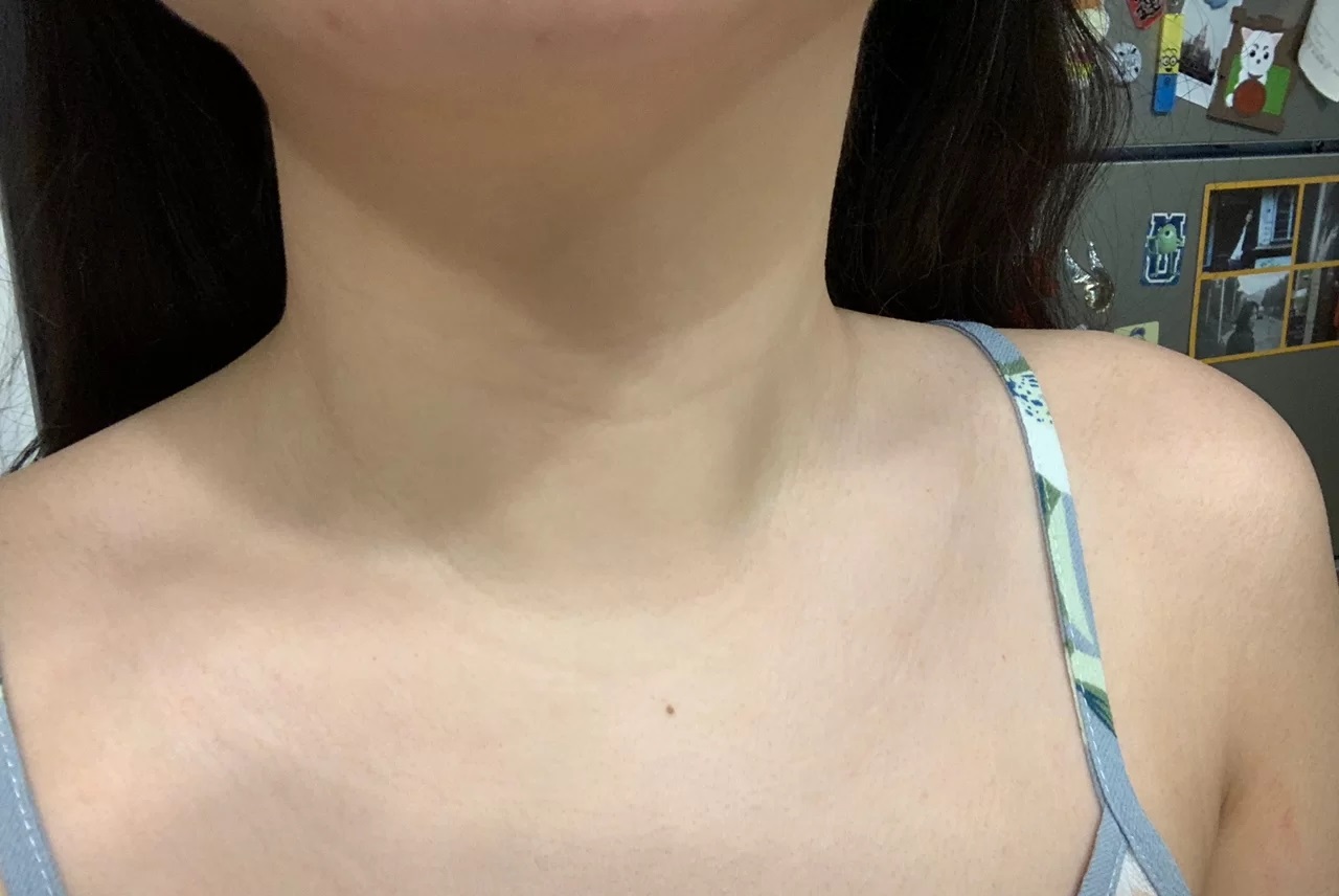 脖子疼痛是甲癌在扩散吗,右耳肿了淋巴结也痛