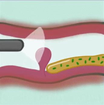 鼻炎长期鼻塞吃什么药,老鼻炎患者怎么治疗