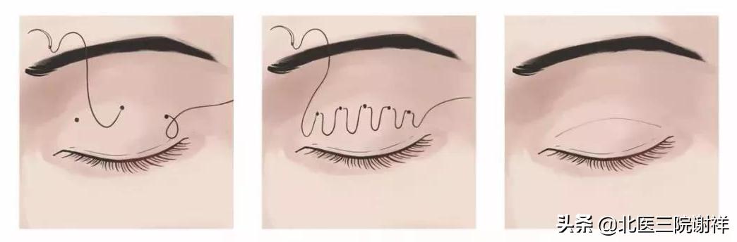 做完双眼皮还是肿着怎么办,全切双眼皮松解后能变回单眼皮吗