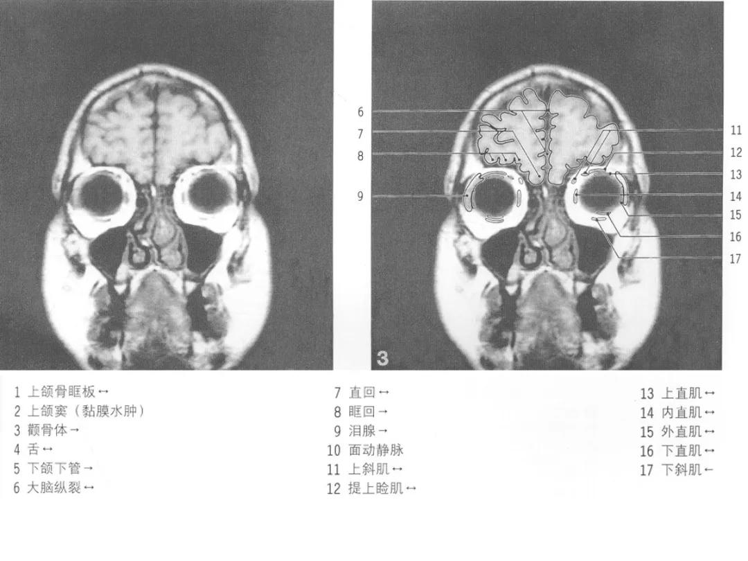 颅脑冠状状切面解剖图,颅脑mr解剖结构图