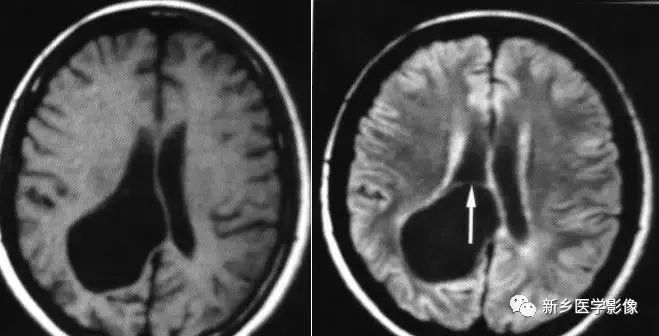 什么引起成人脑室扩大,哪些病可以导致左侧脑室增宽