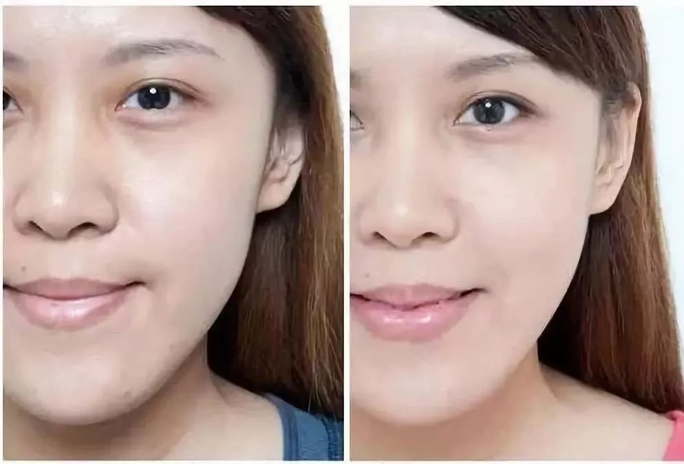 眼部细纹去皱的方法,眼角皱纹多用什么抗皱纹